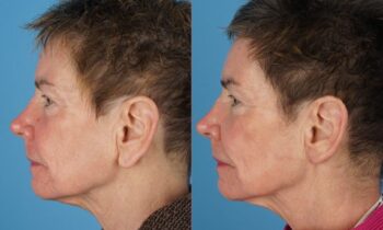 Before and After Otoplasty Jefferson Facial Plastics 1.1