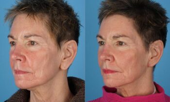 Before and After Otoplasty Jefferson Facial Plastics 1.2