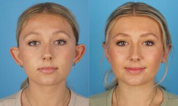 Before and After Otoplasty Jefferson Facial Plastics 2.1