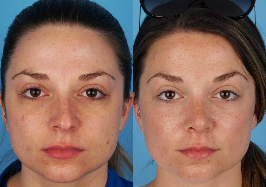 Jefferson Facial Plastics rhinoplasty before and after 1.1