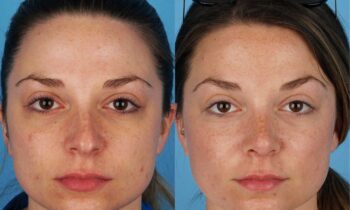 Jefferson Facial Plastics rhinoplasty before and after 1.1