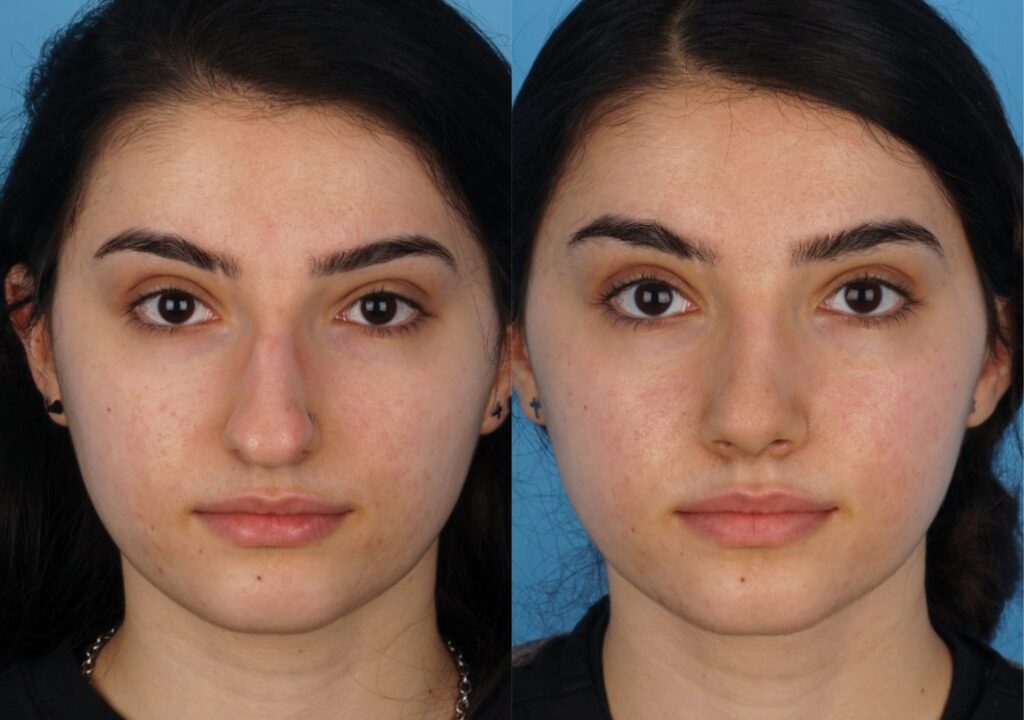 Jefferson Facial Plastics rhinoplasty before and after 20.1