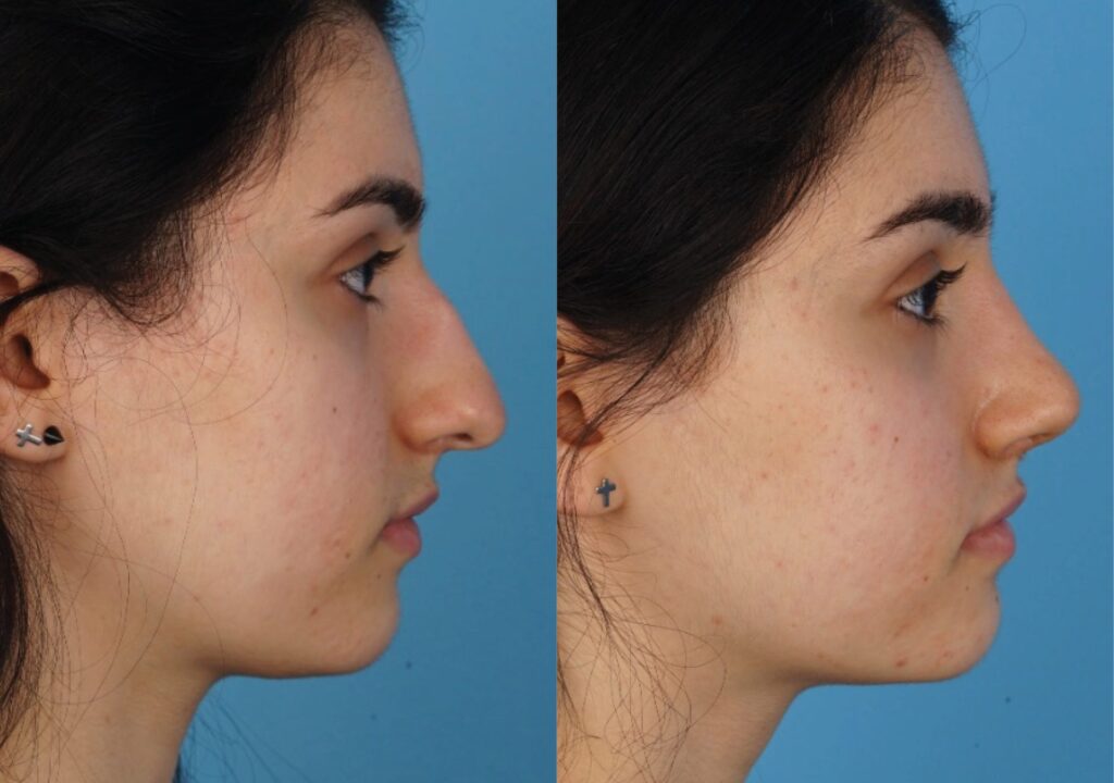 Jefferson Facial Plastics rhinoplasty before and after 20.2