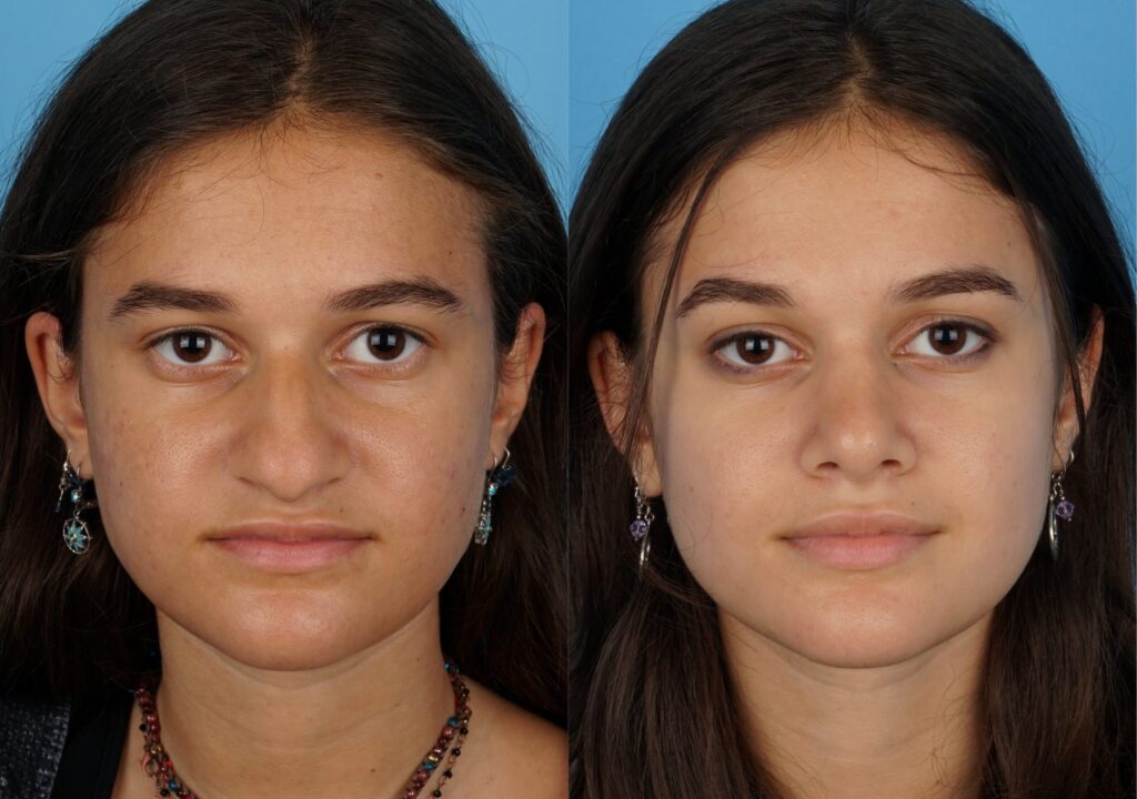 Jefferson Facial Plastics rhinoplasty 22.1