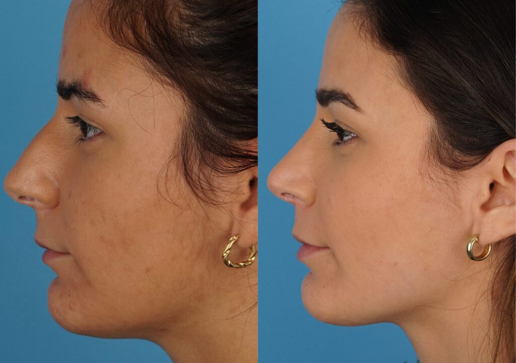 Jefferson Facial Plastics rhinoplasty before and after 23.1