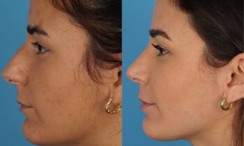 Jefferson Facial Plastics rhinoplasty before and after 23.1