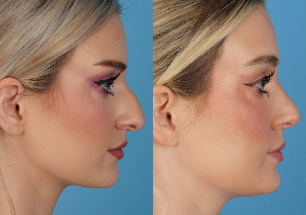 Jefferson Facial Plastics rhinoplasty before and after 25.2