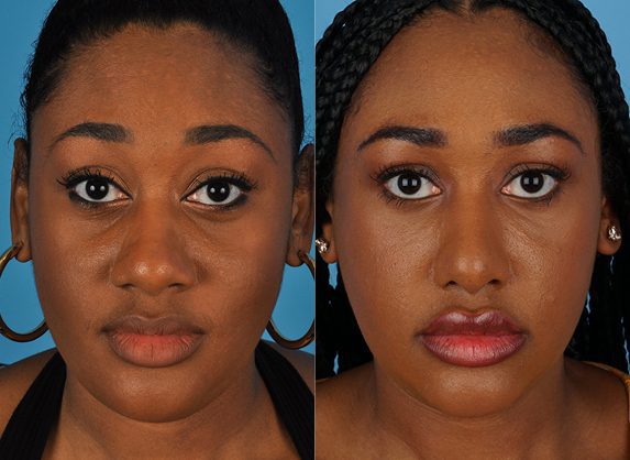 Before and After Photos | Jefferson Facial Plastics